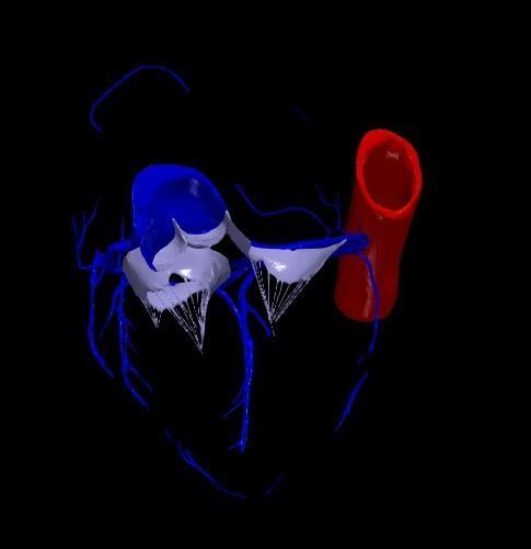 3d model of the heart with tetralogy of Fallot long axis 3D print model_6