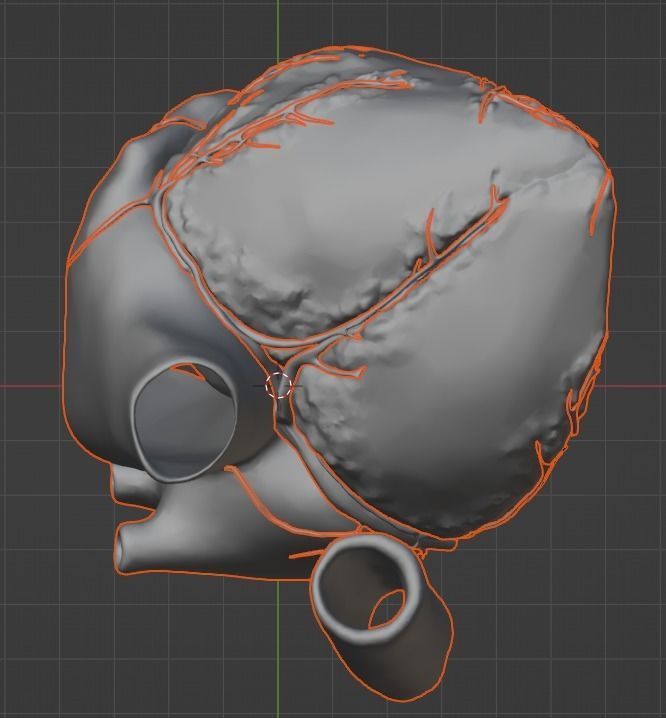3d model of the heart with tetralogy of Fallot long axis 3D print model_14