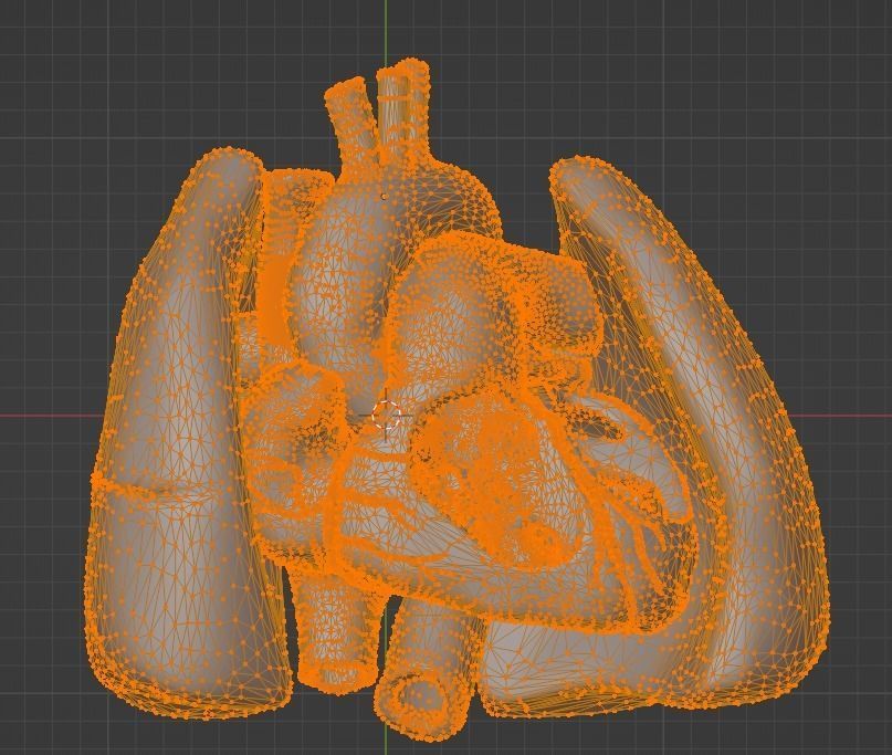 3d model of heart with ventricular septal defect 3D print model_26