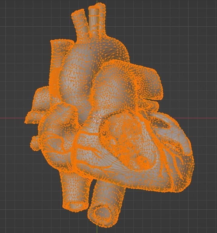 3d model of heart with ventricular septal defect 3D print model_15