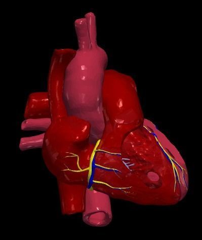 3d model of heart with ventricular septal defect 3D print model_5