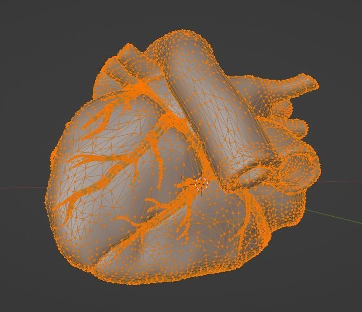 3d model of heart with ventricular septal defect 3D print model_20