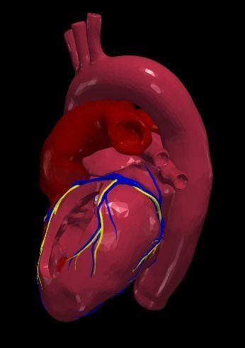 3d model of heart with ventricular septal defect 3D print model_6