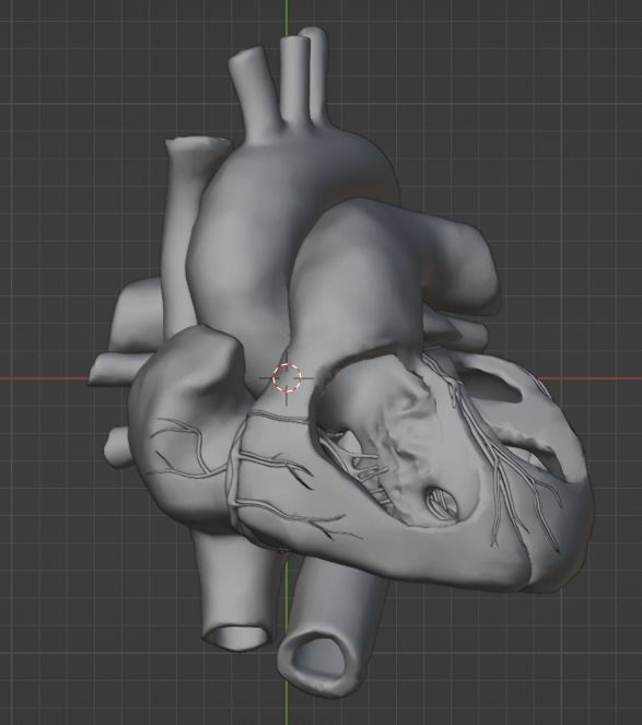 3d model of heart with ventricular septal defect 3D print model_25