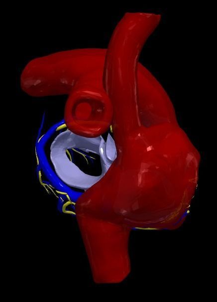 3d model of heart with ventricular septal defect 3D print model_9