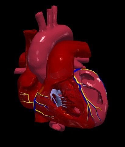 3d model of heart with ventricular septal defect 3D print model_3