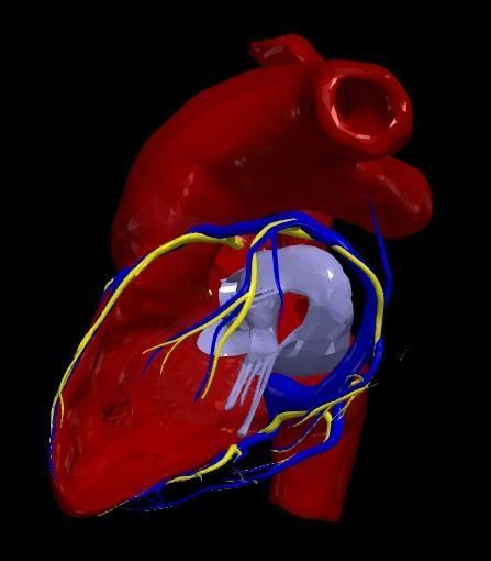 3d model of heart with ventricular septal defect 3D print model_8