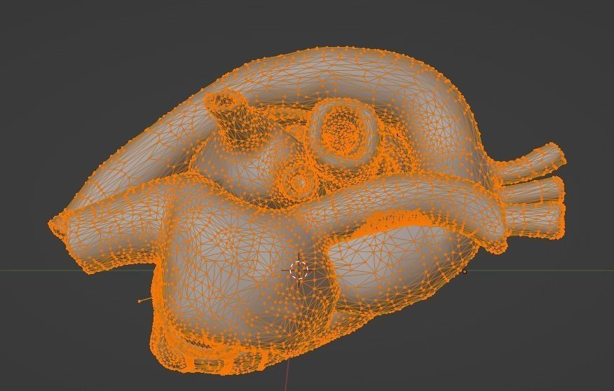 3d model of heart with ventricular septal defect 3D print model_21