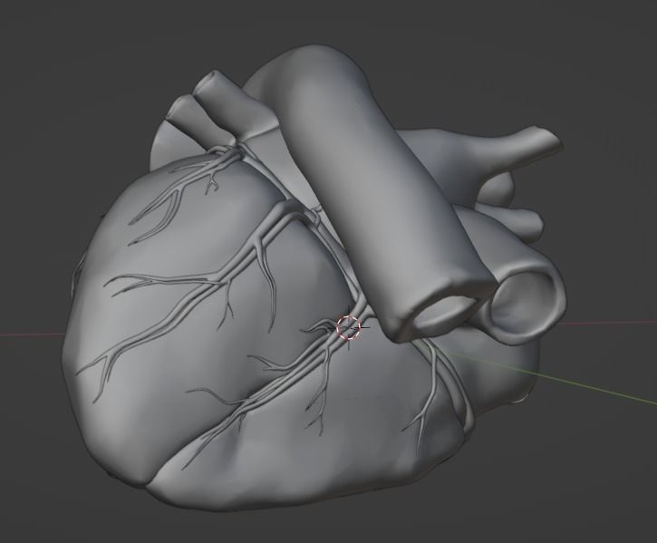 3d model of heart with ventricular septal defect 3D print model_18
