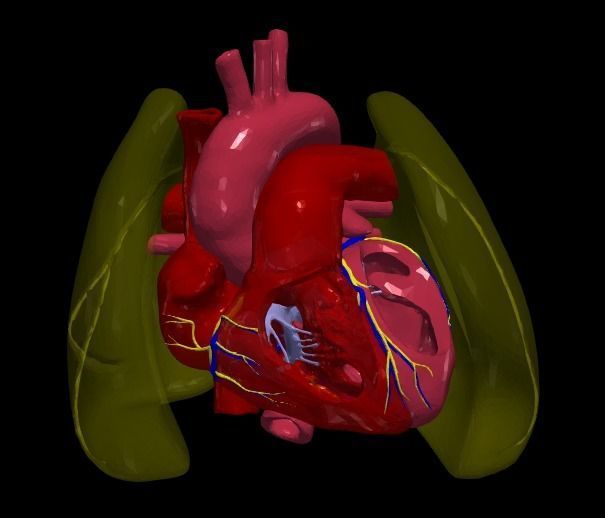 3d model of heart with ventricular septal defect 3D print model_10
