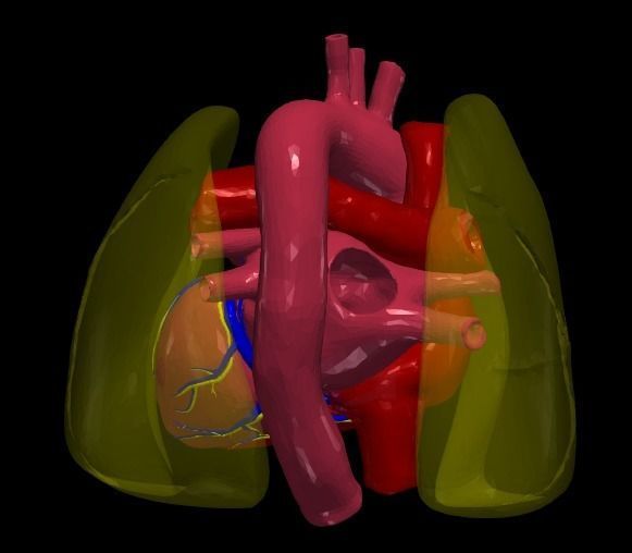 3d model of heart with ventricular septal defect 3D print model_14