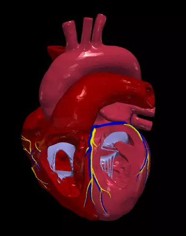3d model of heart with ventricular septal defect 3D print model_0