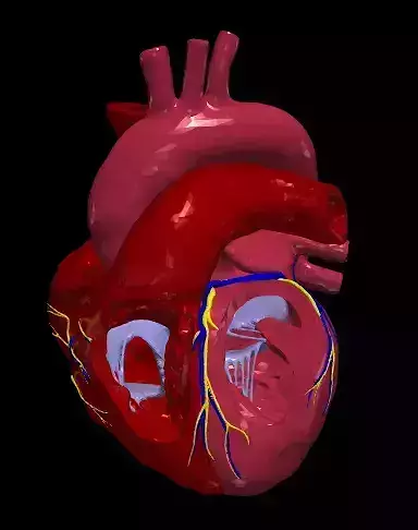 3d model of heart with ventricular septal defect