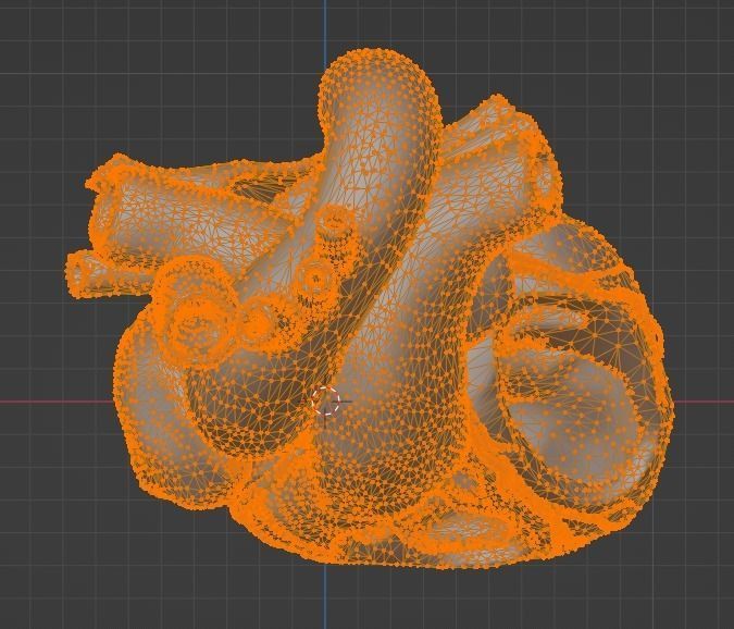 3d model of heart with ventricular septal defect 3D print model_23
