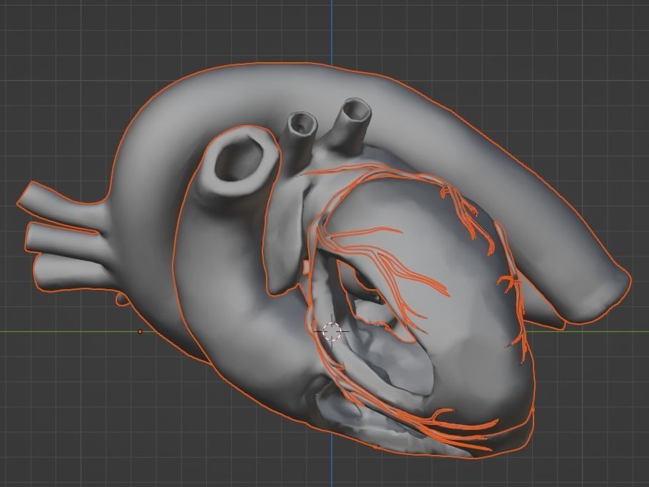 3d model of heart with ventricular septal defect 3D print model_22