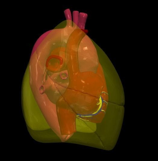 3d model of heart with ventricular septal defect 3D print model_4
