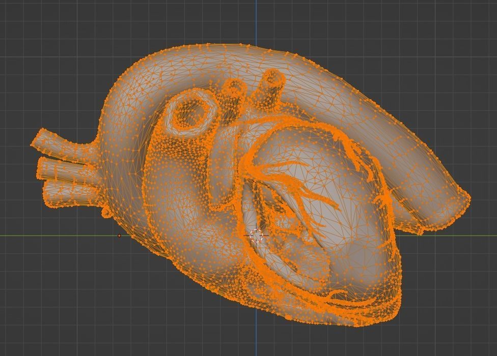 3d model of heart with ventricular septal defect 3D print model_17