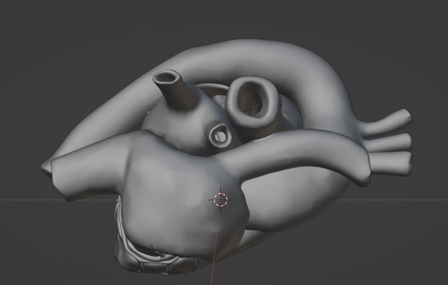 3d model of heart with ventricular septal defect 3D print model_19