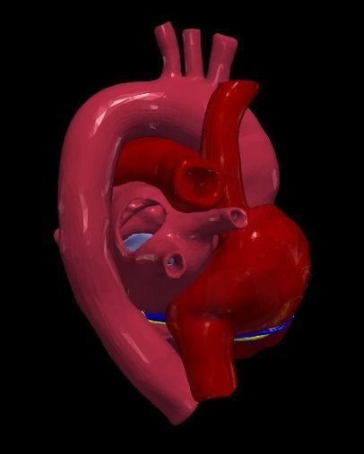 3d model of heart with ventricular septal defect 3D print model_7