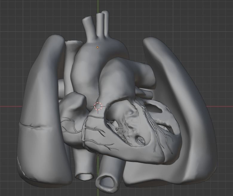 3d model of heart with ventricular septal defect 3D print model_24