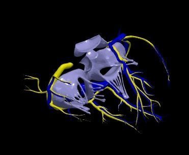 3d model of heart with ventricular septal defect 3D print model_11