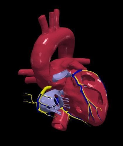 3d model of heart with ventricular septal defect 3D print model_2