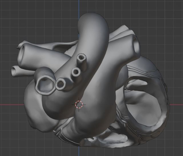 3d model of heart with ventricular septal defect 3D print model_16