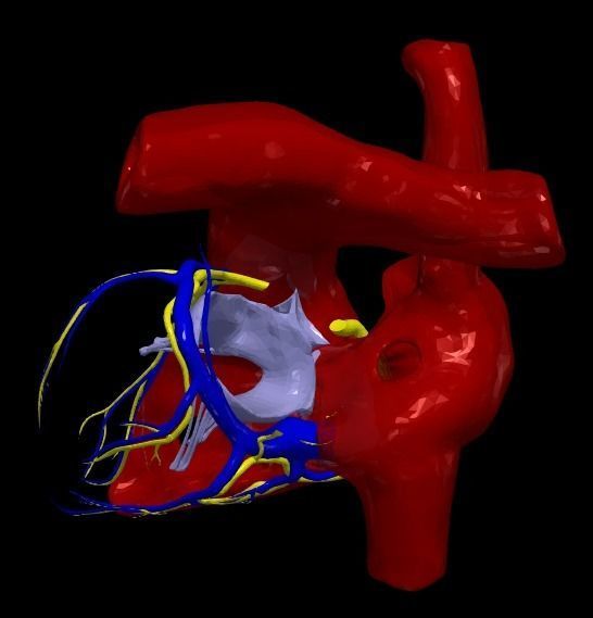 3d model of heart with ventricular septal defect 3D print model_13