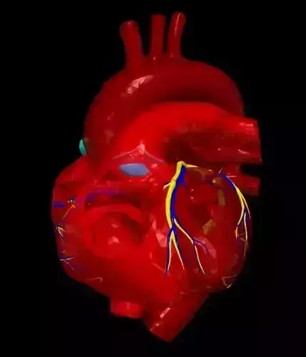 3d model of heart with PAPVC 