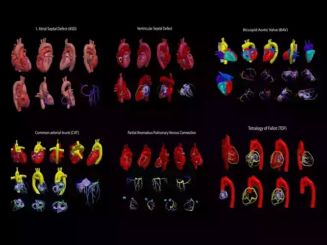 Congenital Heart Disease - 7pack 3D model