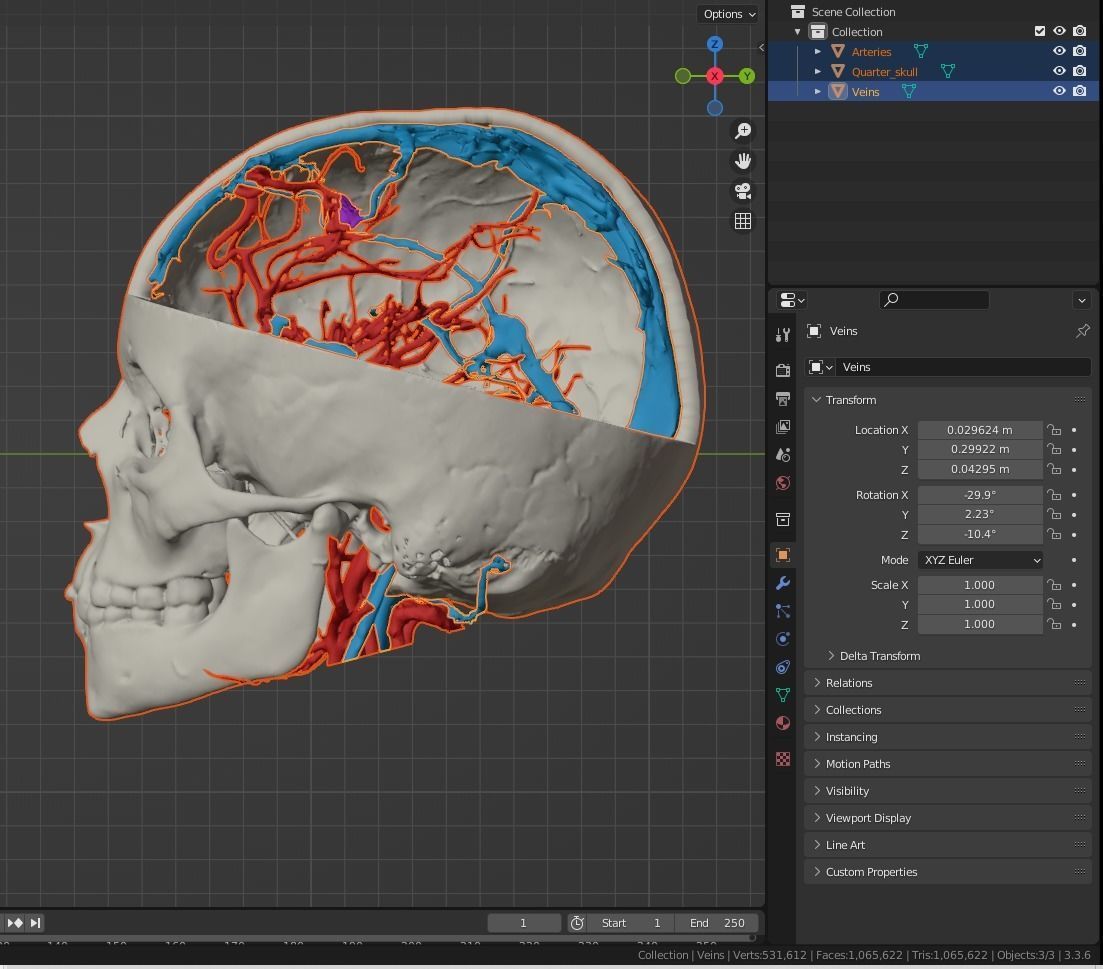3D Model of Brain Arteriovenous Malformation 3D print model_18