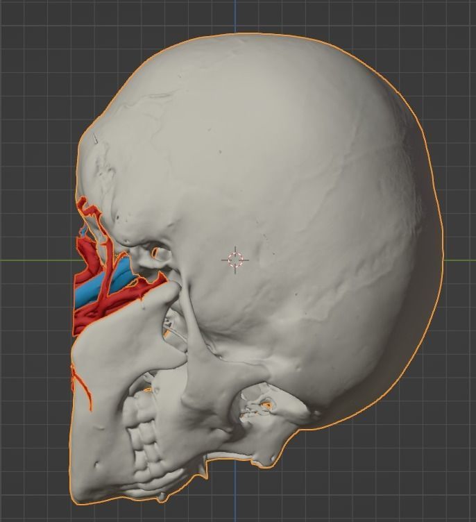 3D Model of Brain Arteriovenous Malformation 3D print model_16