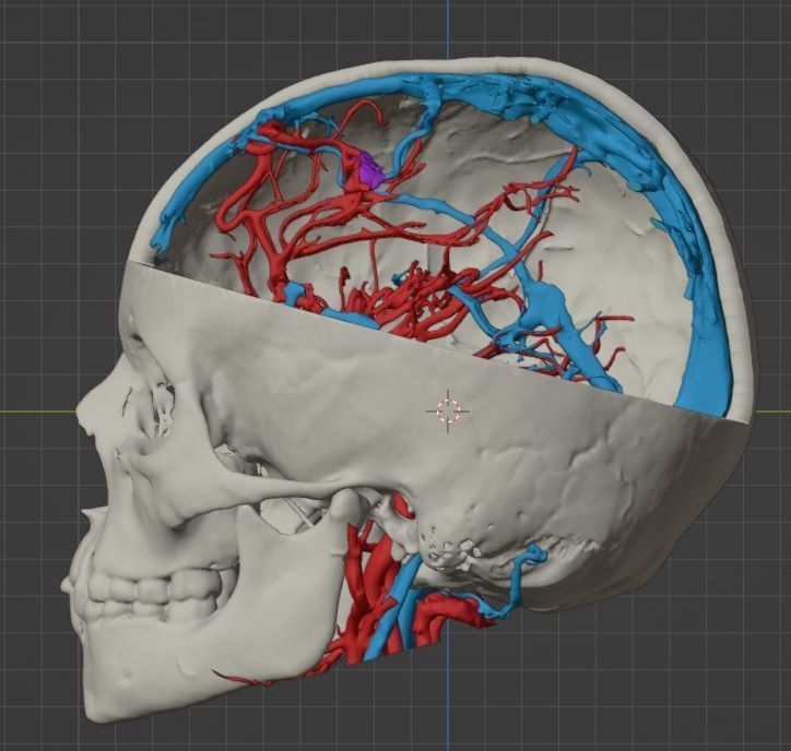 3D Model of Brain Arteriovenous Malformation 3D print model_15