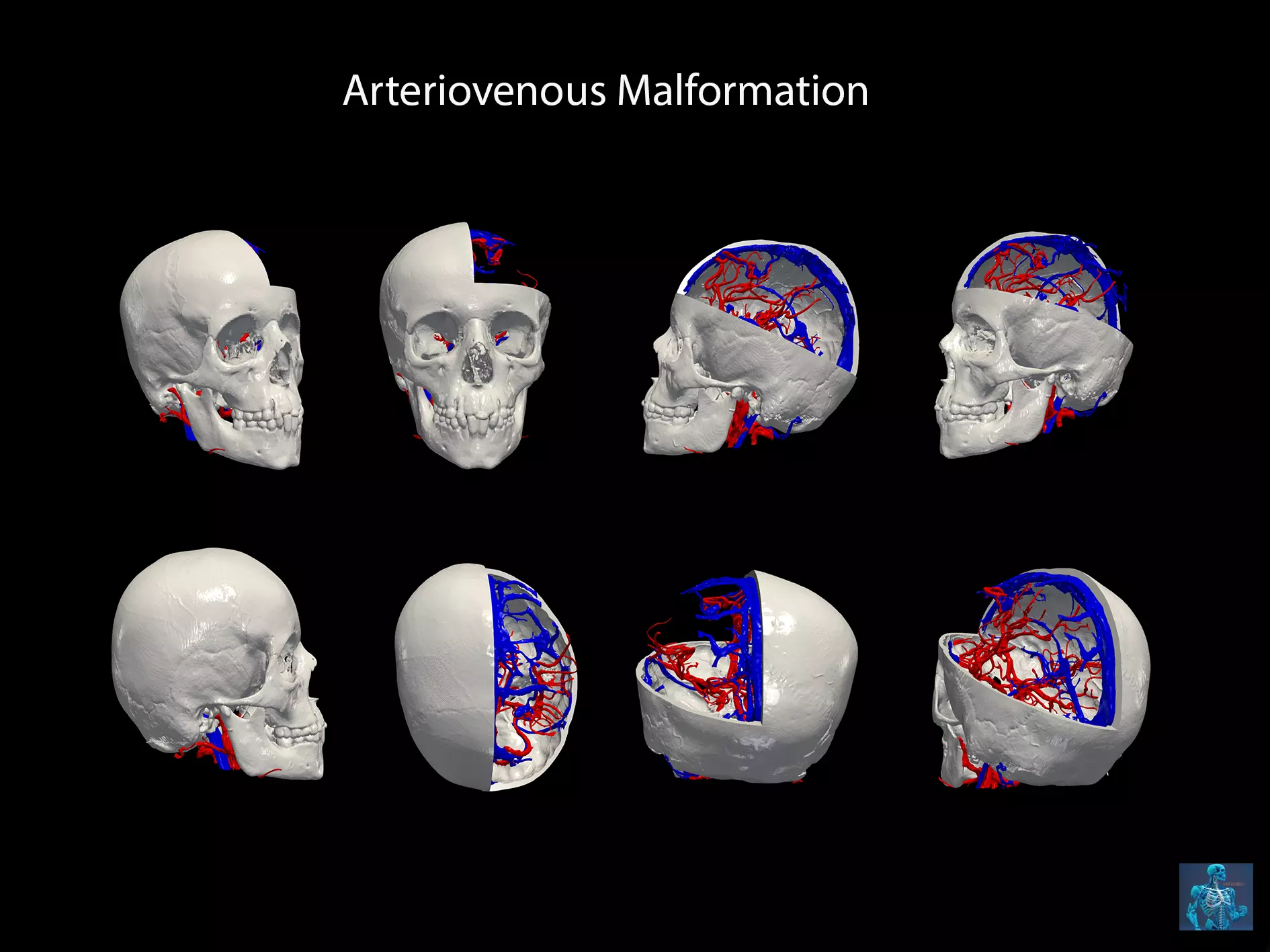 3D Model of Brain Arteriovenous Malformation 3D print model_0