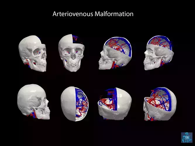 3D Model of Brain Arteriovenous Malformation