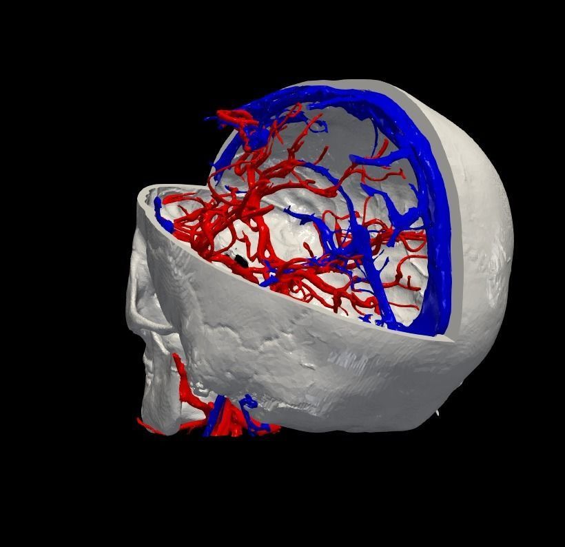 3D Model of Brain Arteriovenous Malformation 3D print model_4