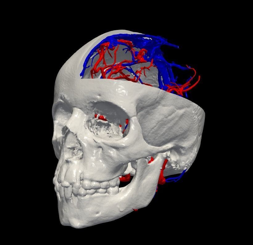 3D Model of Brain Arteriovenous Malformation 3D print model_19