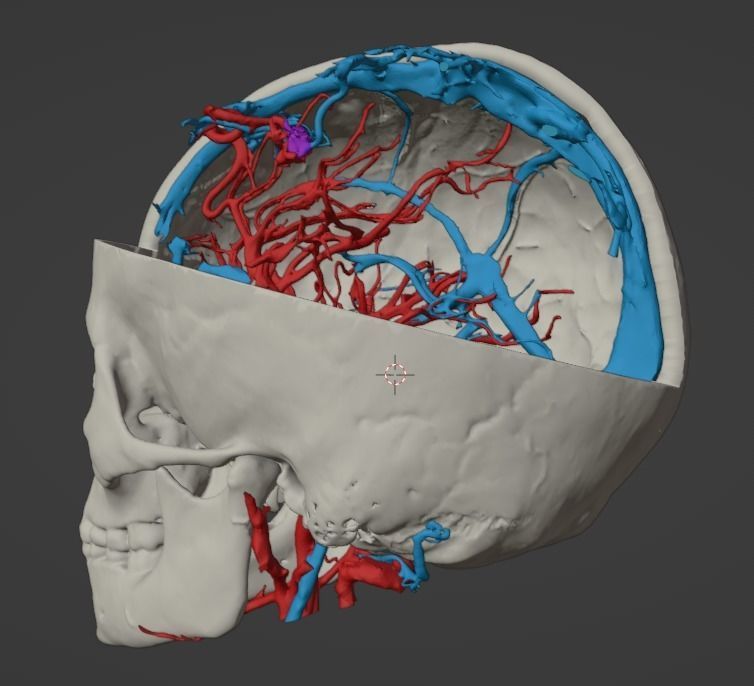 3D Model of Brain Arteriovenous Malformation 3D print model_23