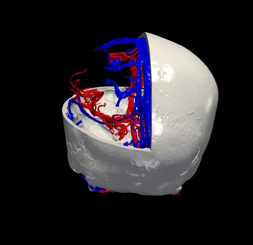 3D Model of Brain Arteriovenous Malformation 3D print model_3