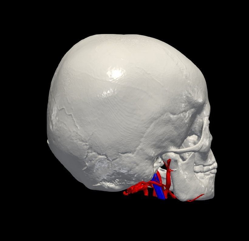 3D Model of Brain Arteriovenous Malformation 3D print model_5