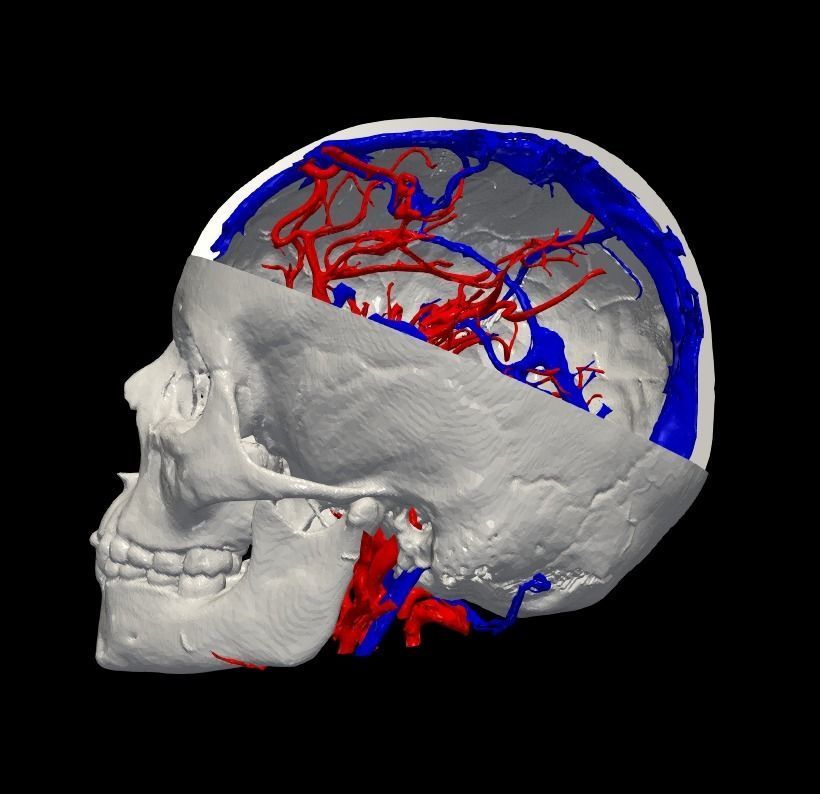 3D Model of Brain Arteriovenous Malformation 3D print model_2
