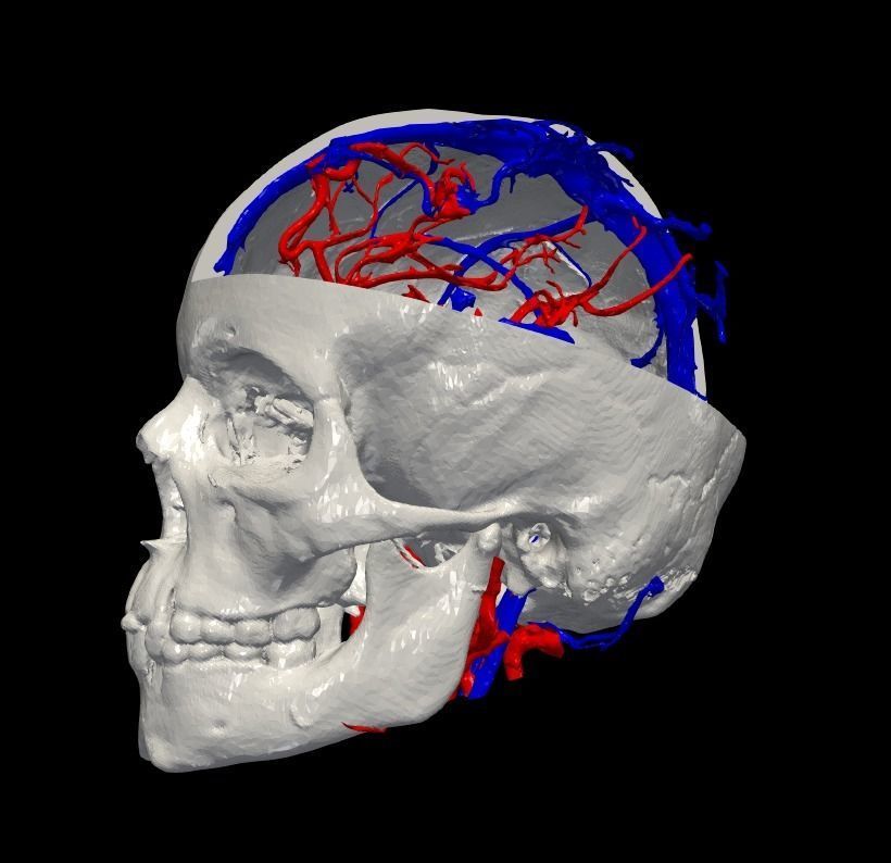 3D Model of Brain Arteriovenous Malformation 3D print model_22