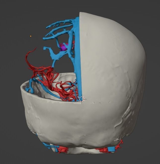 3D Model of Brain Arteriovenous Malformation 3D print model_21