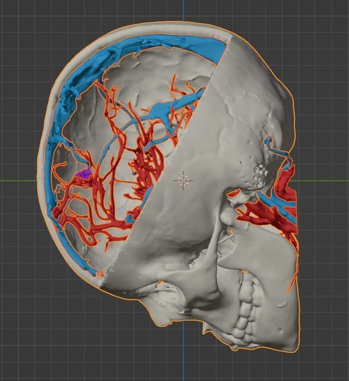 3D Model of Brain Arteriovenous Malformation 3D print model_17