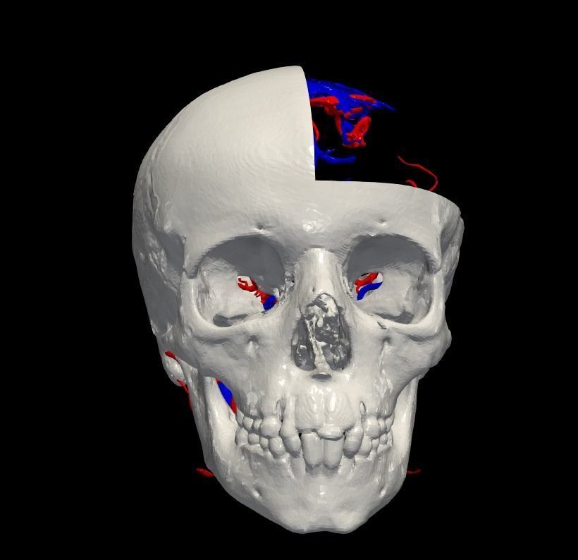 3D Model of Brain Arteriovenous Malformation 3D print model_9