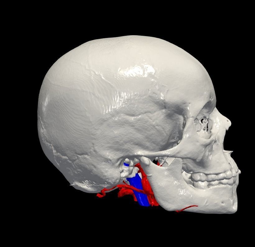 3D Model of Brain Arteriovenous Malformation 3D print model_7