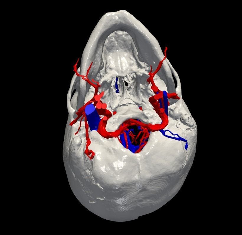 3D Model of Brain Arteriovenous Malformation 3D print model_8