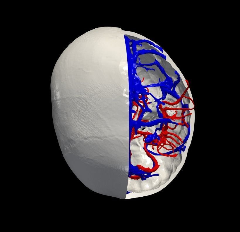 3D Model of Brain Arteriovenous Malformation 3D print model_12