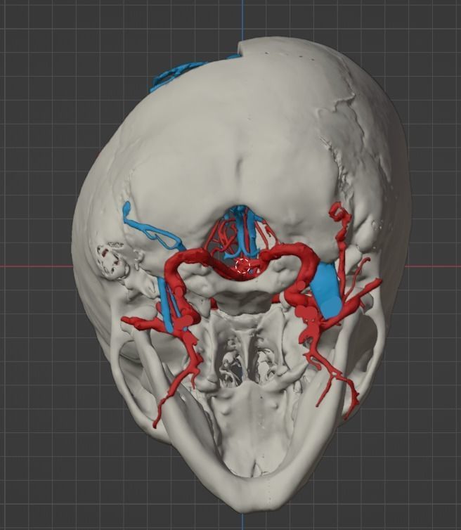3D Model of Brain Arteriovenous Malformation 3D print model_13