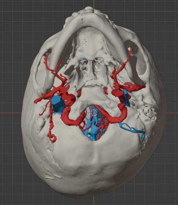 3D Model of Brain Arteriovenous Malformation 3D print model_20